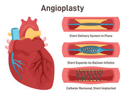 angioplastystenting